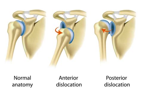 Dislocated Shoulder | Instability | Orthopedic Shoulder Specialist ...