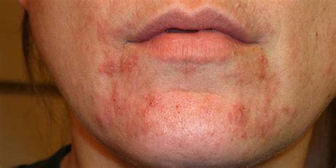 5 Common Symptoms Of Staph Infection On Face - Early Signs Of Staph ...