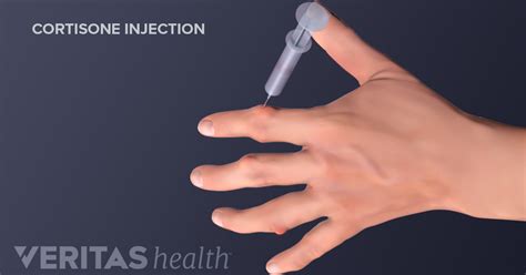 Cortisone Injection Risks and Side Effects