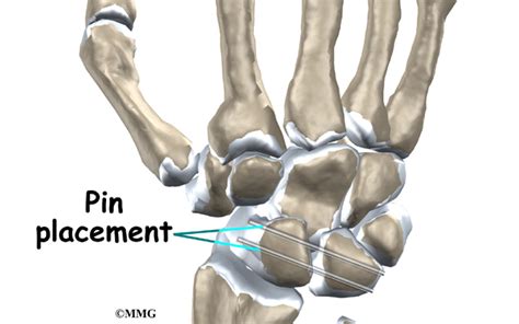 Wrist Ligament Injuries | eOrthopod.com