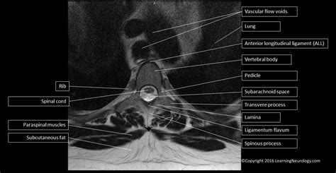 Cervical Spine MRI Axial View