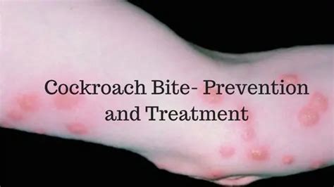 Cockroach bite symptoms Archives - Mobility Physiotherapy Clinic