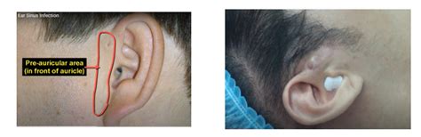 preauricular cyst excision