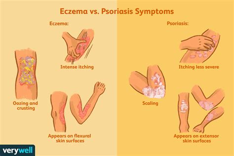 How Eczema and Psoriasis Are Different