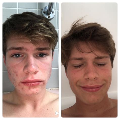 Just got off accutane. Before and after for inspiration~ : r/acne