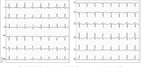 Figure 5 from Wellens’ Syndrome: Focus on Diagnosis and Choice of ...