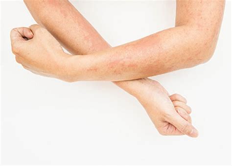 Dry Skin Rash On Arms