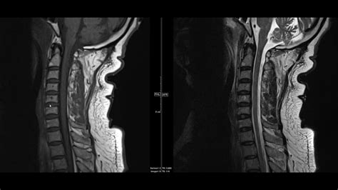 Cervical Spine Mri Comparison