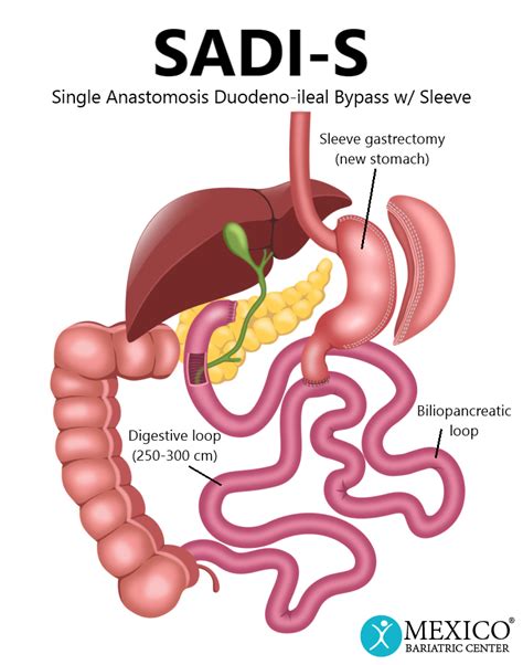 Single-Anastamosis Duodenal Switch - Mexico Bariatric Center