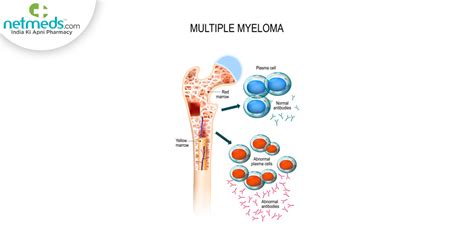 Myeloma - AnaumAlegria