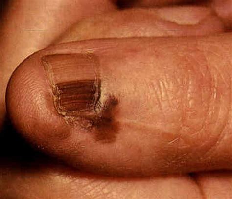 Acral Lentiginous Melanoma - Pictures, Symptoms, Causes, Treatment ...