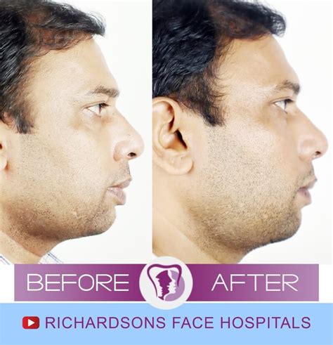 Lip Reduction Surgery – Richardson's Plastic Surgery Hospitals