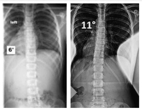 Mild Scoliosis: Treatment, Exercises, and Symptoms - Hudson Valley ...