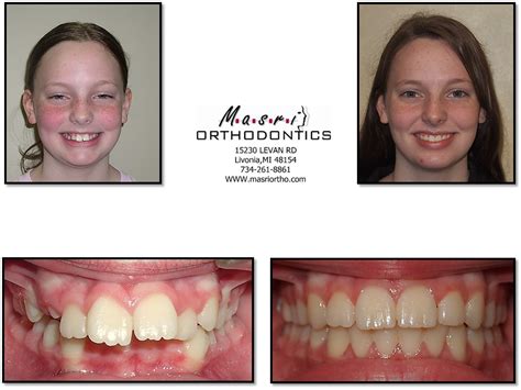 Braces Before And After Overbite