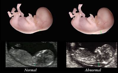 Nuchal Translucency - Test, Ultrasound, Normal Range, Results