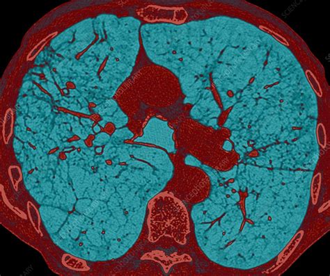 Emphysema, CT scan - Stock Image - C014/7012 - Science Photo Library