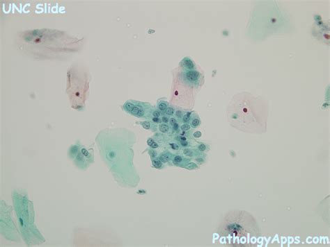 ascus cytology