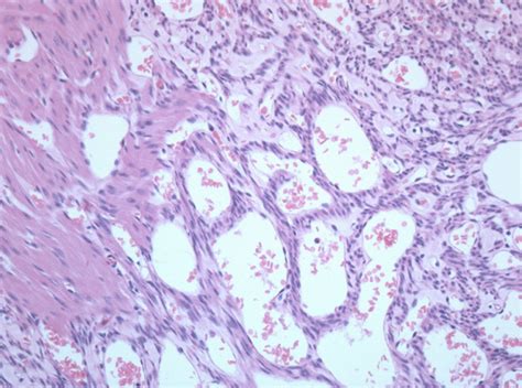 Histology of the angioleiomyoma with H&E staining. | Download ...