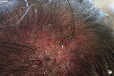 Folliculitis On Scalp