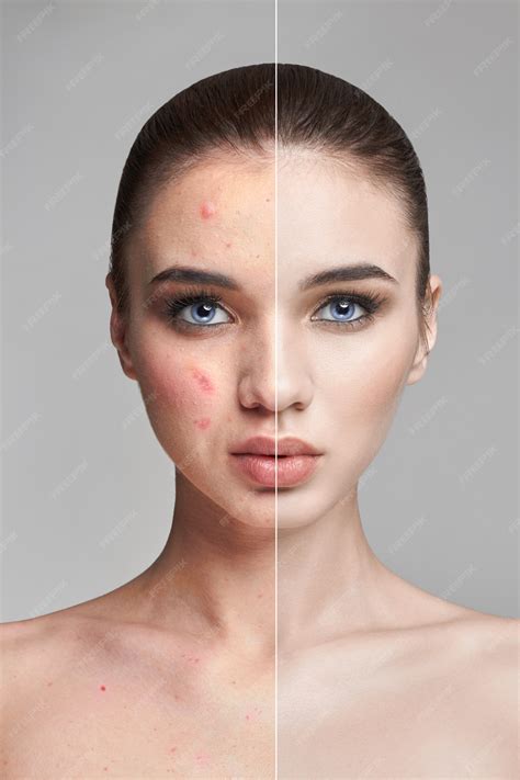 Premium Photo | Pimples and acne on woman face before and after