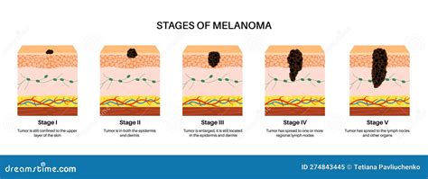 Melanoma