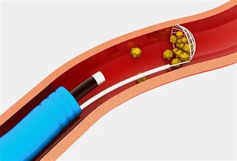 How Painful Is a Cystoscopy?