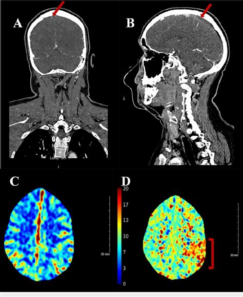 CT Angiogram and Perfusion Scans of the Head (A) Coronal and (B ...