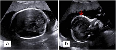 Craniosynostosis Ultrasound