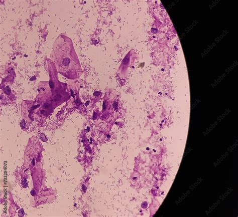 Pap's smear. Microscopic examination of pap smear showing inflammatory ...