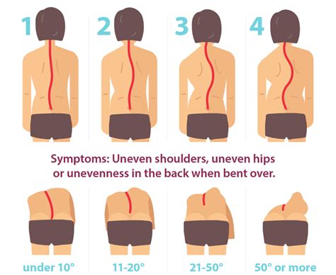 Scoliosis