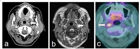 Representative false positive imaging findings of retropharyngeal lymph ...