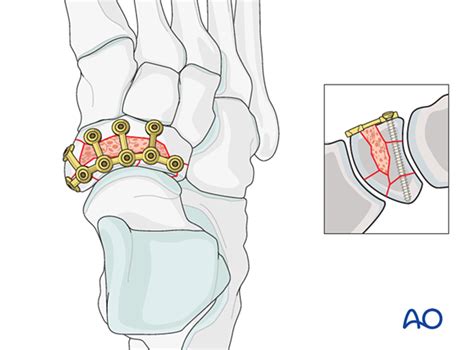 ORIF - Navicular plate for Complete articular navicular fracture