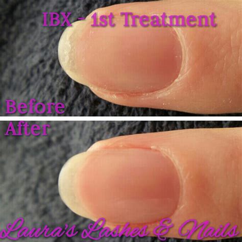 IBX Rejuvenates Chemo Patients’ Nails | Nailpro