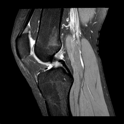 Normal Knee Mri Scan