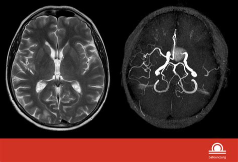 Cerebral Aneurysm Angiogram