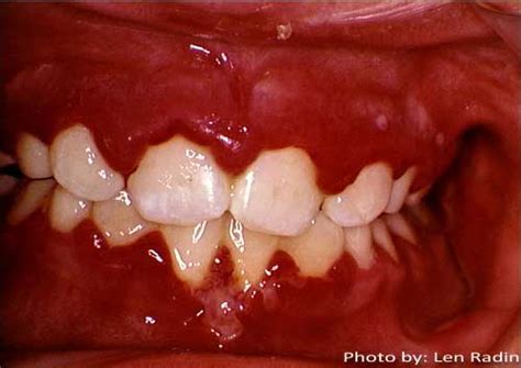 Medical Videos ppt and Lecture Notes: Necrotizing ulcerative gingivitis