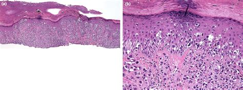 Acral Lentiginous Melanoma Histology