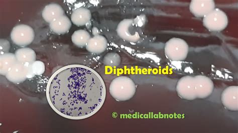 Keynotes diphtheria bacillus and Diphtheroids Archives - Medical Notes