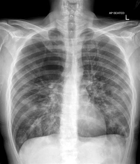 Emphysema Chest X Ray