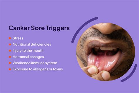 Canker Sores On Tongue Treatment Selling Discounts | dpise2022.dps ...