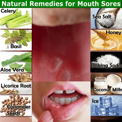 12 Natural Remedies for Mouth Sores that Work - NaturalRelieved