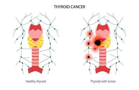 Premium Vector | Thyroid cancer stages