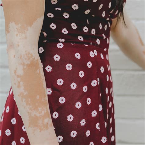 5 Types of Vitiligo and What They Mean | Living Dappled