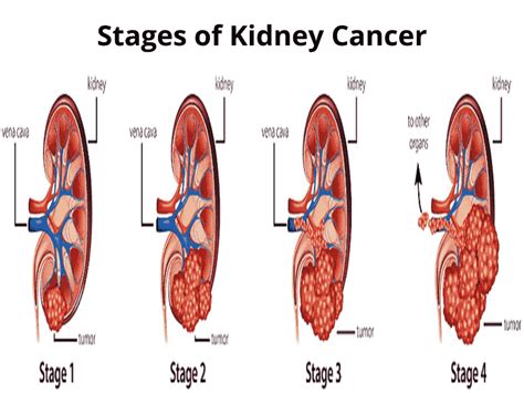 You Need To Know About Stages of Kidney Cancer- Dr Rudra Acharya