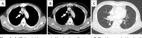 Figure 1 from Four Cases of Mediastinal Lymph Node Carcinoma of Unknown ...