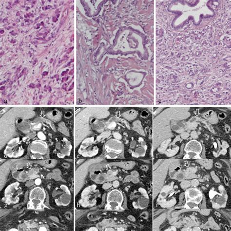 Pancreatic ductal adenocarcinoma of the neck of the pancreas: histology ...