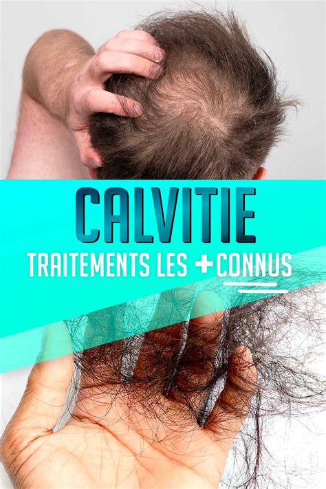 calvitie traitement : Les 2 médicaments les plus connus