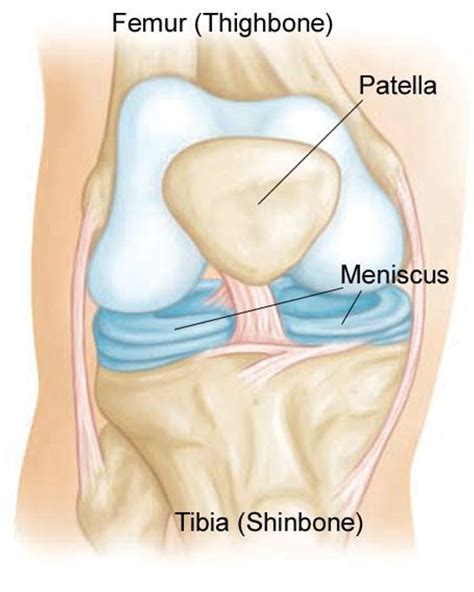 Torn Meniscus