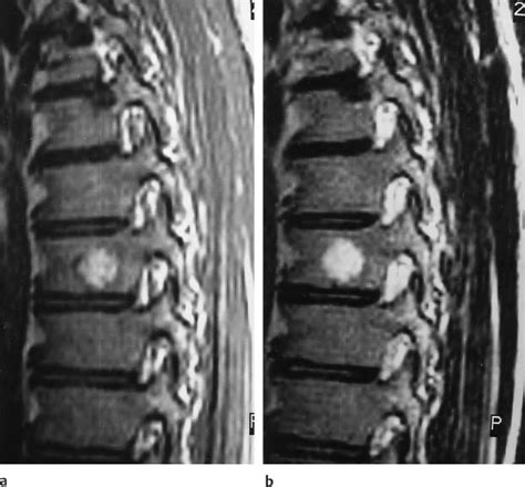 Spine | Radiology Key