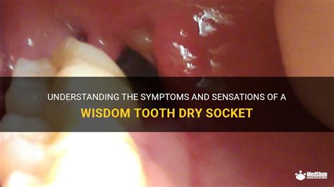 Understanding The Symptoms And Sensations Of A Wisdom Tooth Dry Socket ...